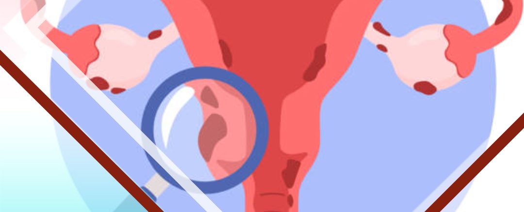 آندومتریوز چیست؟