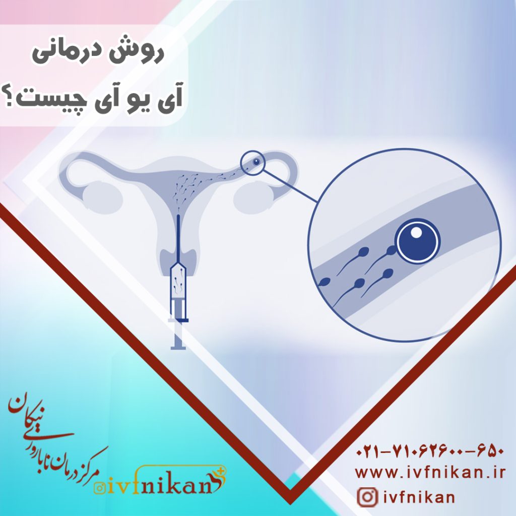 روش درمانی آی یو آی به چه کسانی توصیه می شود